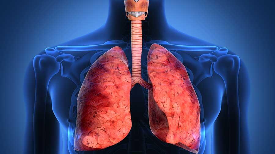 Éxito del trasplante de células alveolares para tratar la fibrosis pulmonar idiopática