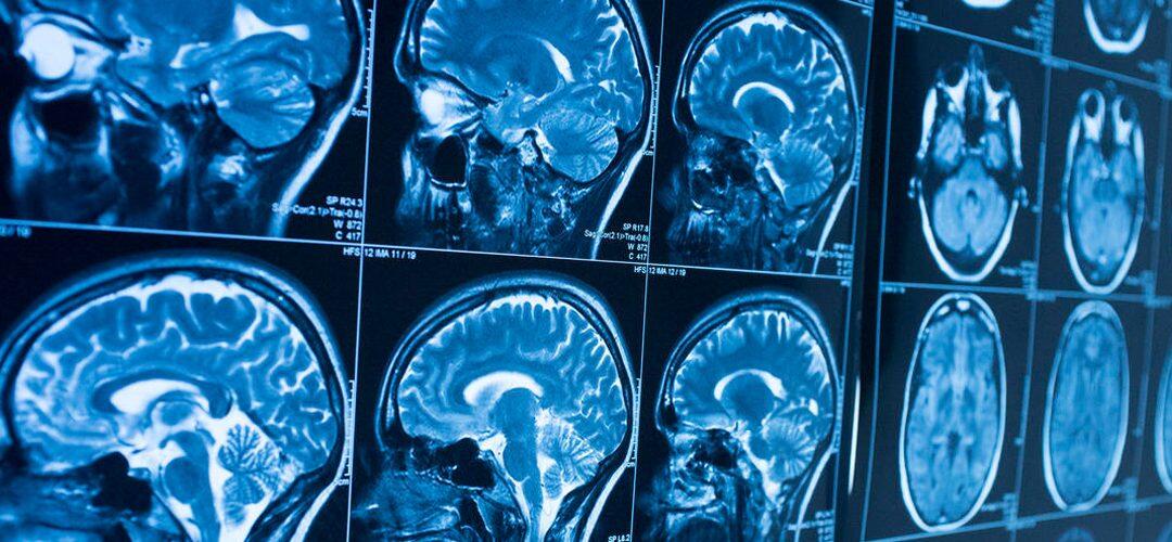 Nouvelles perspectives pour le traitement des cancers du cerveau