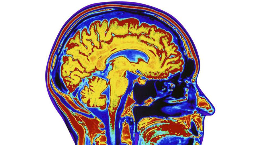 Estimulación cerebral mejora visión a pacientes que la han perdido glaucoma: estudio