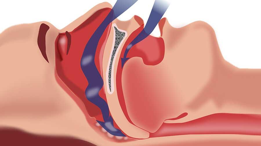 Asocian la apnea con el riesgo cardíaco, aun tras eliminar obstrucciones arteriales