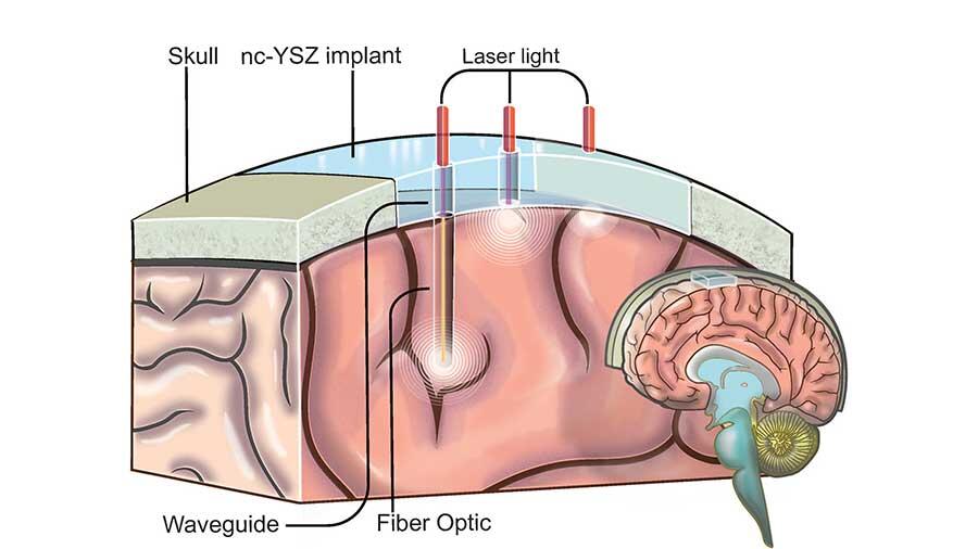 Nuevo implante craneal transparente abre una ‘ventana al cerebro