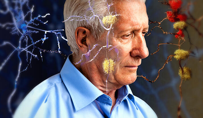 The genetic risk of Alzheimer’s can be detected in young adults