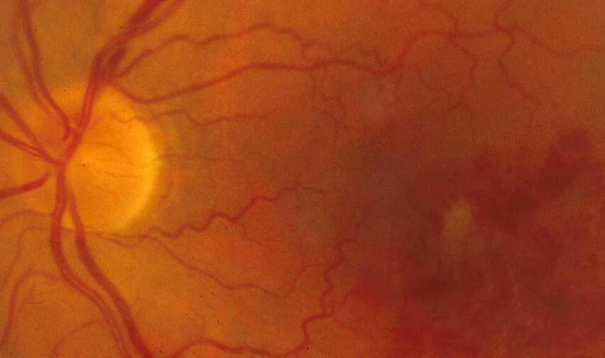 اللطخة الصفراء في العين… الاكتشاف المبكر يضمن الشفاء ويبعد خطر فقدان البصر