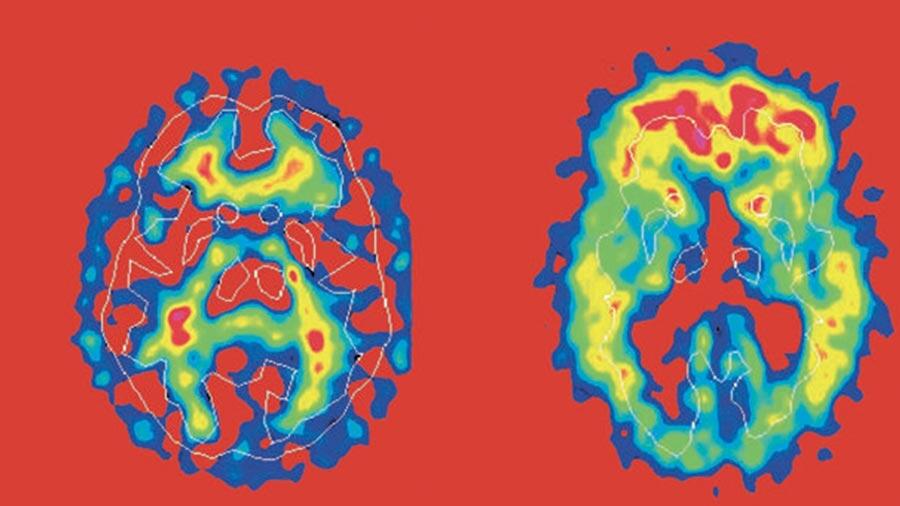 Medicamentos para dolores de la menstruación podrían servir al tratar el Alzheimer