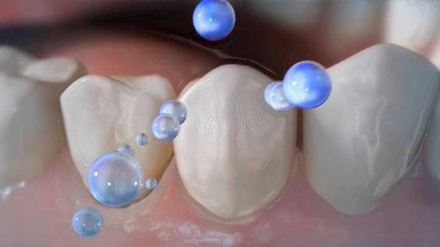 Nanopartículas para destruir la placa dental y las bacterias culpables de ella