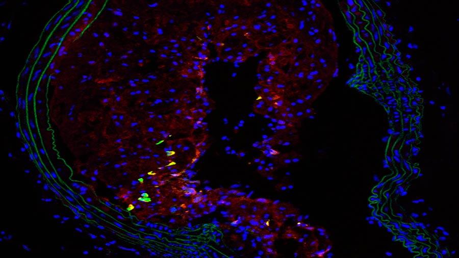 Identifican un nuevo mecanismo implicado en la aterosclerosis