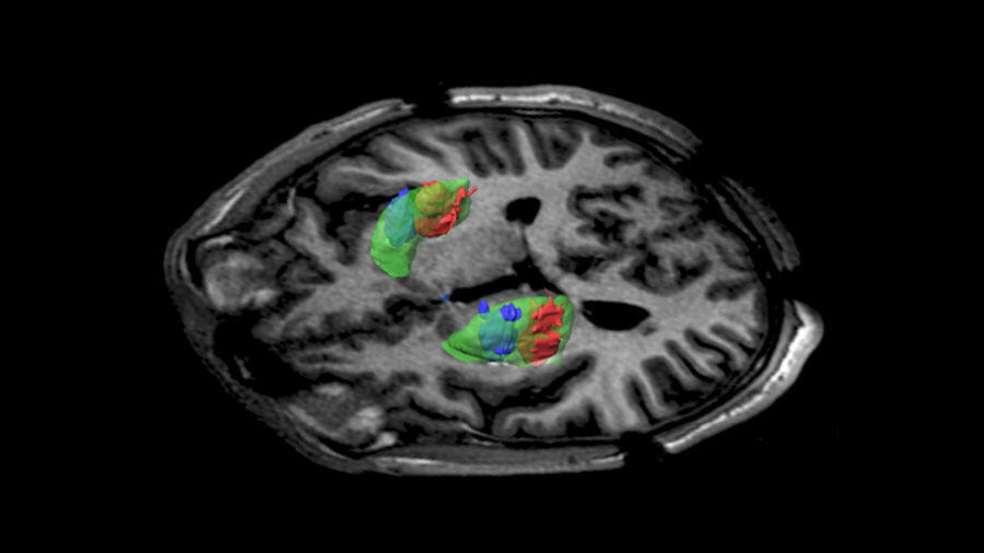 Una inyección de virus con ADN en el cerebro intenta luchar contra el Párkinson