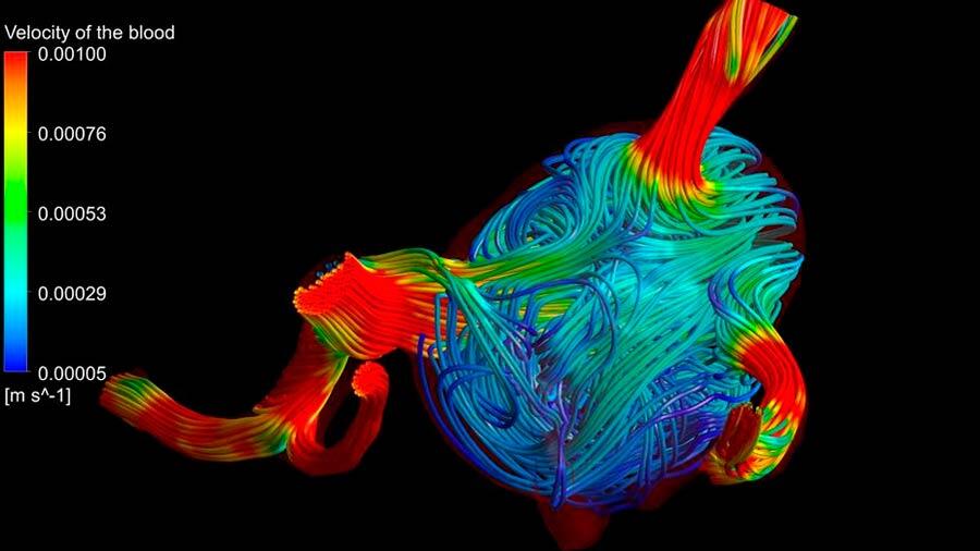 Modelan el flujo sanguíneo en un aneurisma cerebral