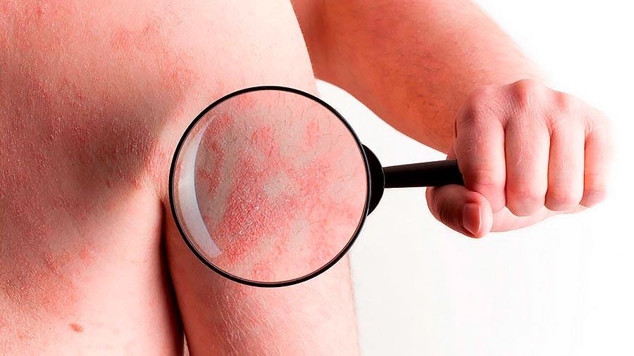 Psoriasis, enfermedad que reduce 3 años el índice de vida