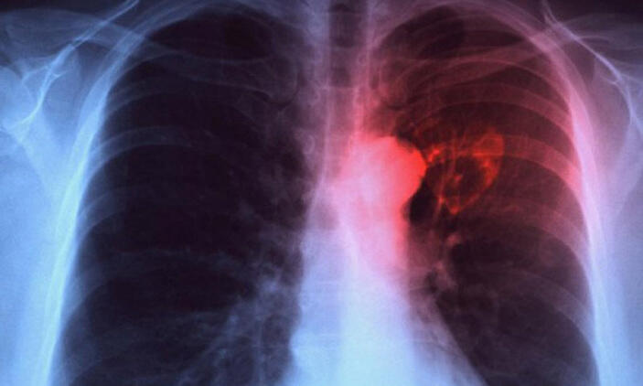 Tuberculosis epidemic larger than previously thought