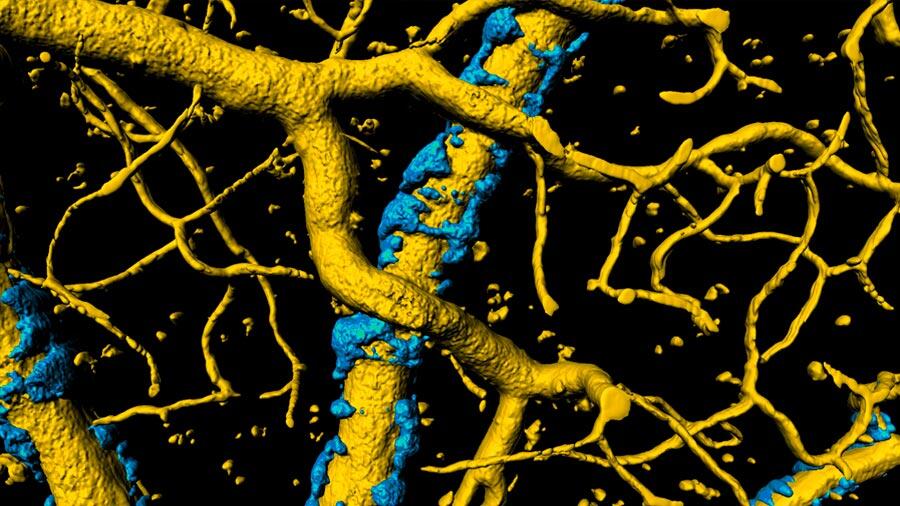 La presencia de peroxinitrito en el cerebro promueve el desarrollo del alzhéimer