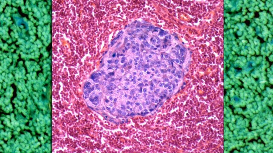 El cáncer se alimenta de grasas saturadas para hacer metástasis