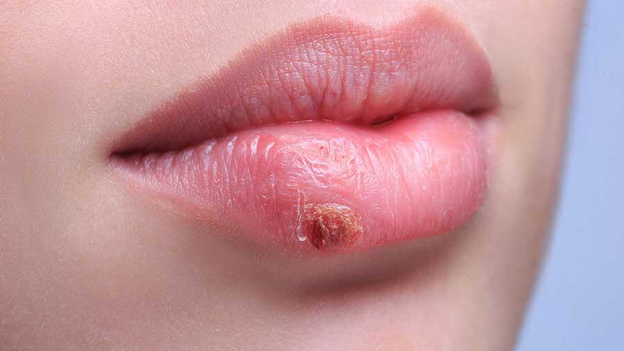 Hallan sorprendente relación del herpes simple con el alzhéimer