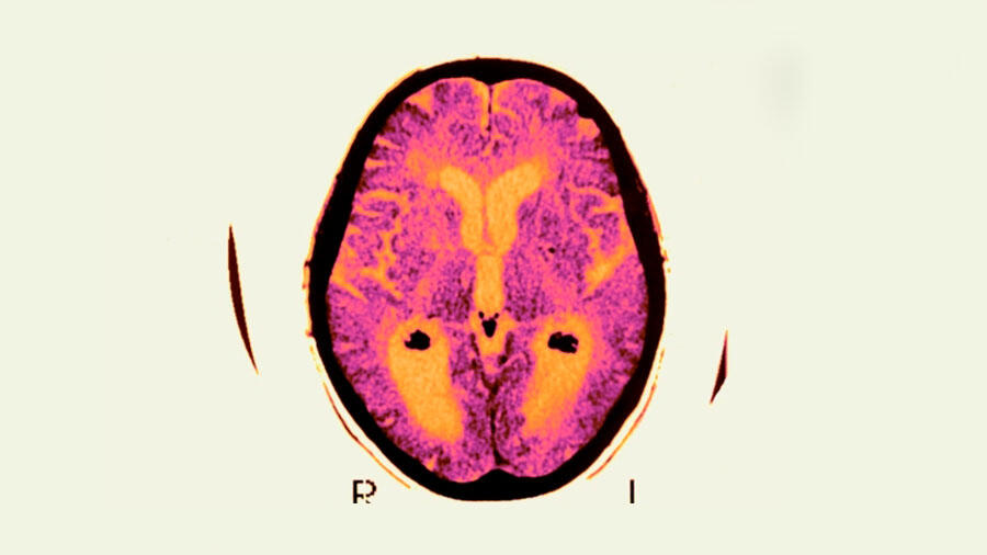 Fracaso en ensayo sobre el Alzhéimer no mata a la principal teoría sobre la enfermedad
