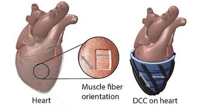 Robotic sleeve ‘hugs’ failing hearts