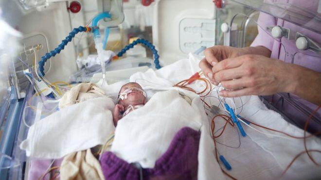 Outlook for extremely premature babies ‘improving’