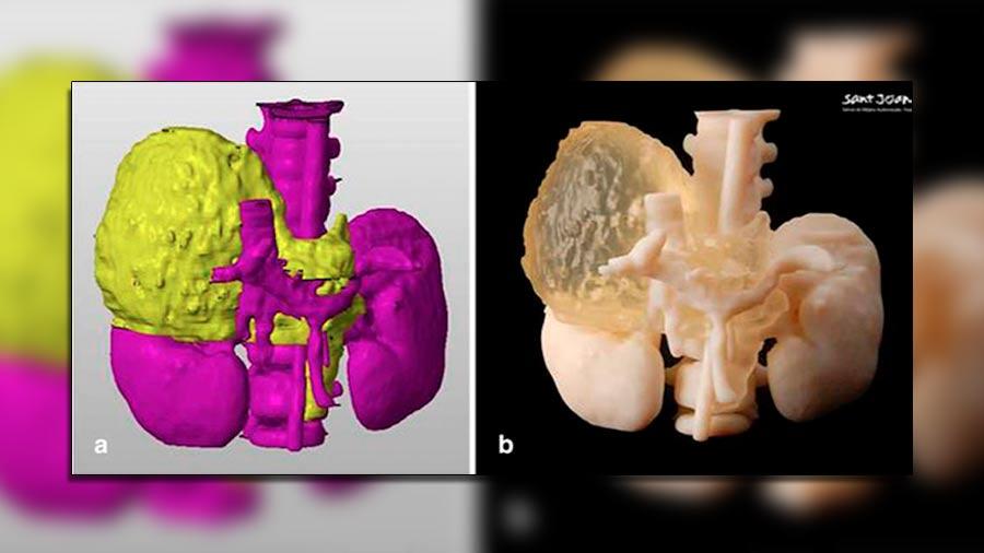 El cirujano que imprime tumores en 3D para combatir el cáncer infantil