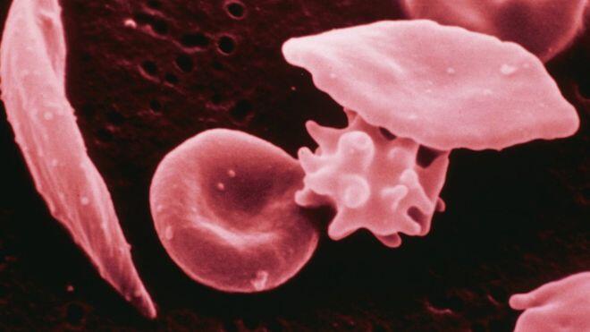 Teenager’s sickle cell reversed with world-first therapy