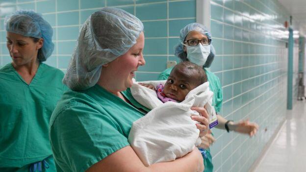 Risky operation removes parasitic twin from baby