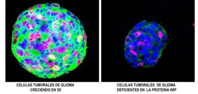 Identifican una proteína clave en la progresión de tumores cerebrales