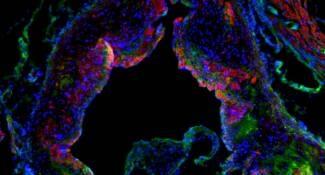 La molécula cortistatina reduce el número y tamaño de las placas de grasa en el sistema cardiovascular