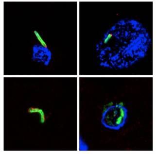 Nuevas infecciones microbianas en cerebros de personas fallecidas por enfermedad de Alzheimer