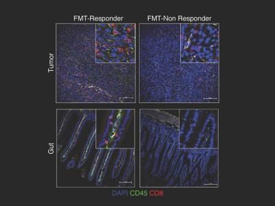 Cómo influyen los microbios intestinales en la respuesta del paciente de cáncer a la inmunoterapia