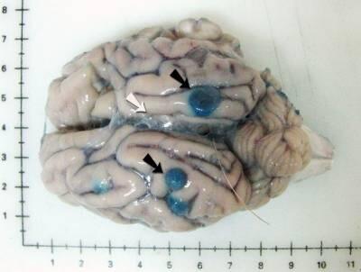 Encuentran cómo reducir la inflamación en el tratamiento habitual de la neurocisticercosis