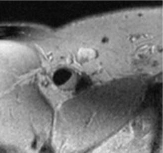 El colesterol LDL, principal responsable modificable de aterosclerosis en personas sin factores de riesgo