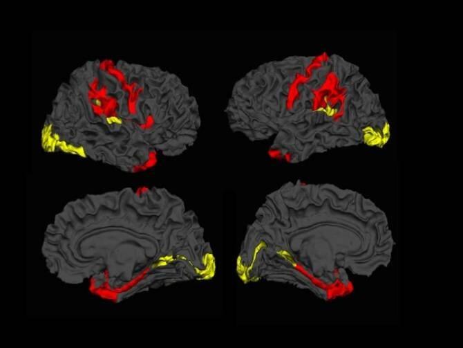 Hallan una capacidad innata del cerebro para luchar contra la esquizofrenia