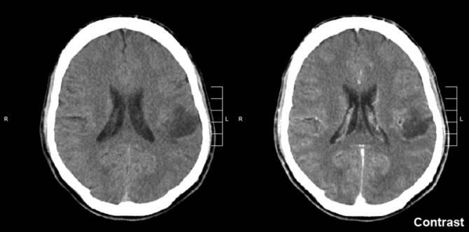 Avances para aumentar la eficacia en el tratamiento de gliomas y melanomas