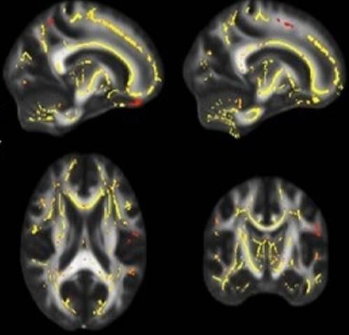 Ejercicio físico para prevenir el Mal de Alzheimer