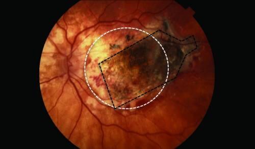 Un implante de retina frena la ceguera causada por la degeneración macular