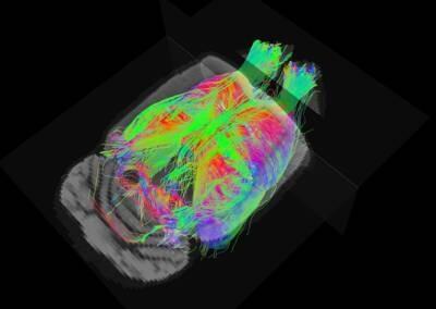 La resonancia magnética detecta de forma precoz alteraciones cerebrales en alzhéimer