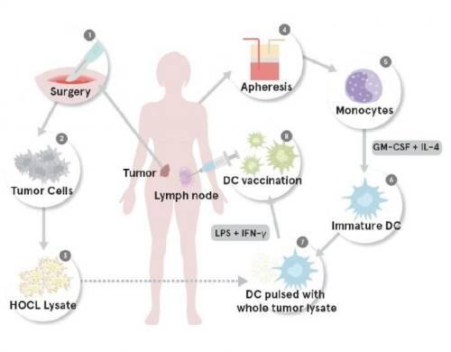 Entrenamiento del sistema inmune para combatir el cáncer de ovario