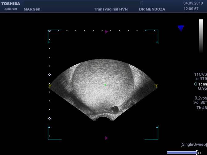 La melatonina es eficaz contra la endometriosis