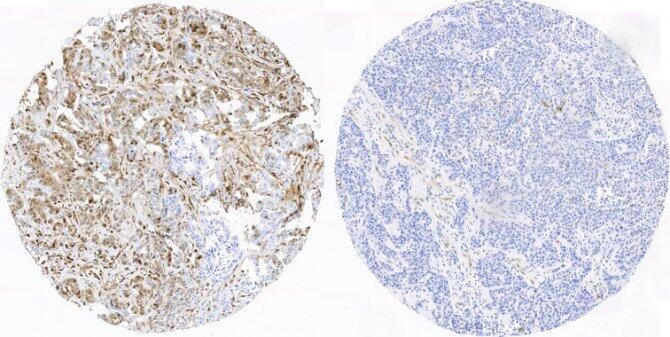 Primeros indicadores de pronóstico para el cáncer de mama más agresivo