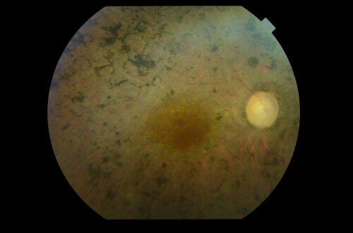 Pacientes con retinosis pigmentaria en primera línea de salida