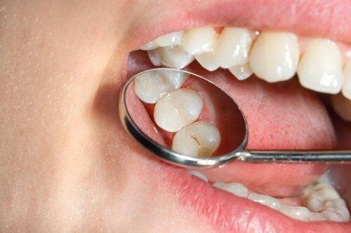 1547745669_archive_1_Dientes_caries_shutterstock_1050606914