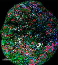 Un tratamiento combinado de inmunoterapia y cirugía demuestra efectos beneficiosos en el tumor cerebral maligno más frecuente