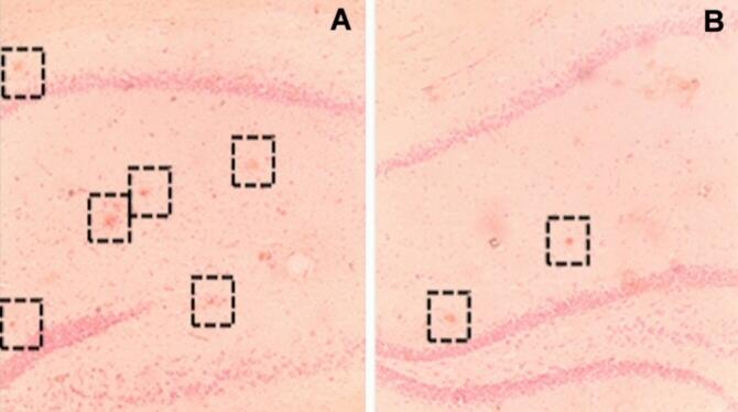 Las actividades físicas y sociales protegen el cerebro contra los daños causados por el alzheimer