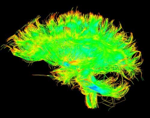 La UVa y el Hospital Clínico emplean la teoría de grafos para redefinir la esquizofrenia