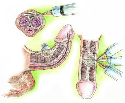 Nueva terapia para pacientes con enfermedad de Peyronie