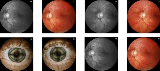 Un aparato portátil permite diagnosticar enfermedades oculares a distancia