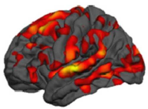 Los diferentes perfiles clínicos de la enfermedad de Huntington se asocian a dos firmas neurales específicas