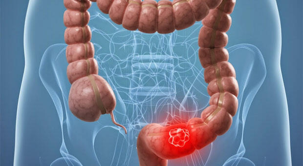 La actividad física desde la adolescencia reduce en un 39% el riesgo de aparición adenomas colorrectales