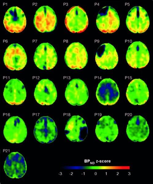 Una única lesión cerebral traumática puede tener consecuencias a largo plazo para la cognición