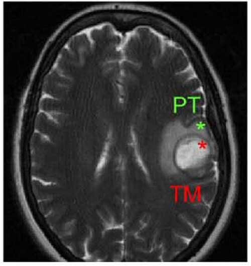 Impiden, en ratones, la progresión del tumor cerebral más agresivo