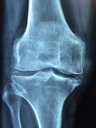 Descubierto un panel de biomarcadores para el diagnóstico temprano de la osteoartritis de rodilla